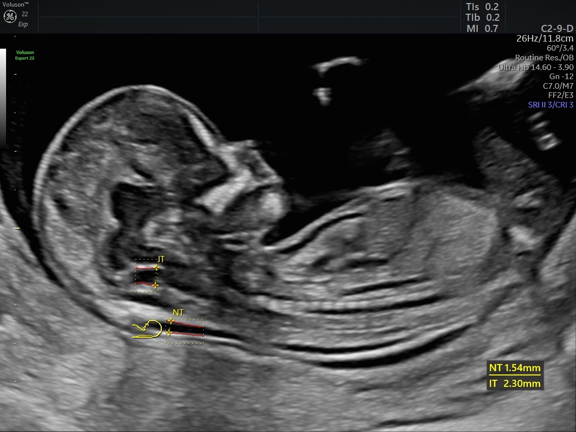 سونوگرافی NT (Nuchal translucency ultrasound)