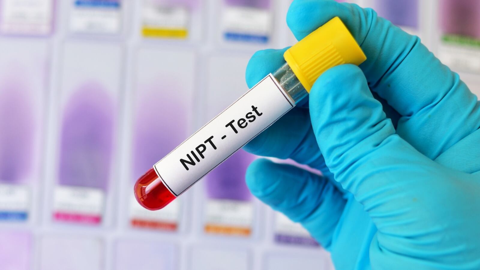 آزمایش NIPT (آزمایش سل فری)