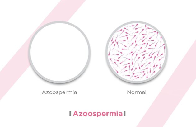 آزواسپرمی چیست؟