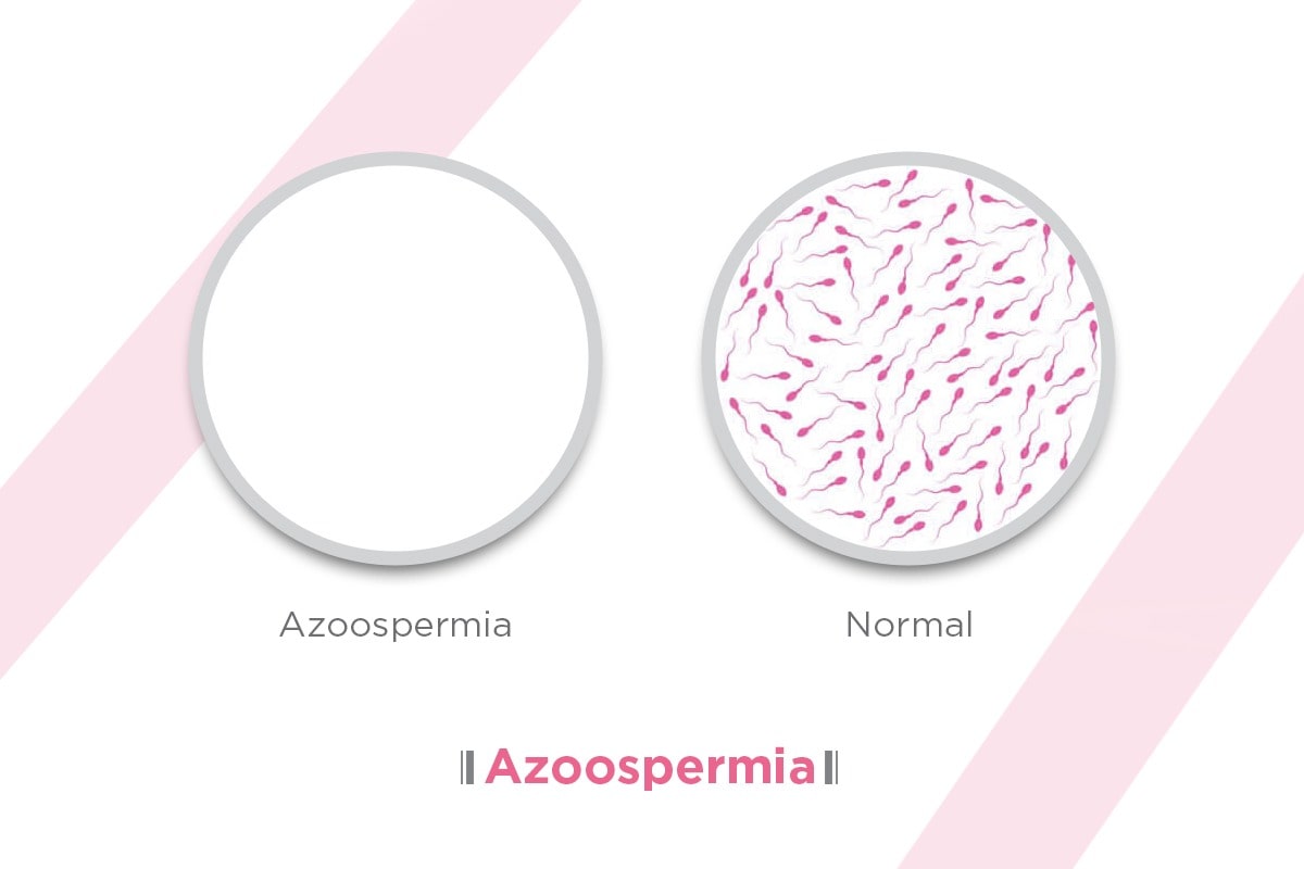 آزواسپرمی چیست؟