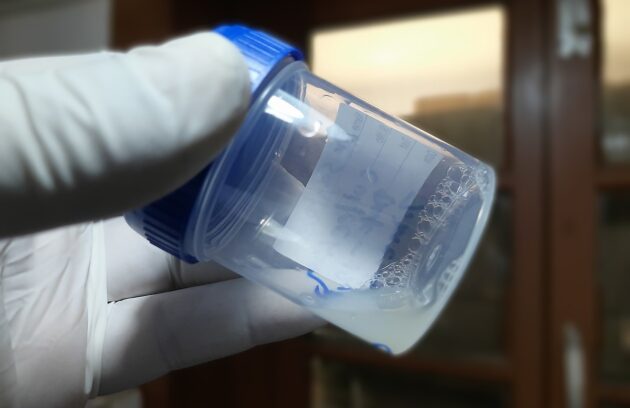 آزمایش اسپرم در آزمایشگاه چگونه انجام میشود؟