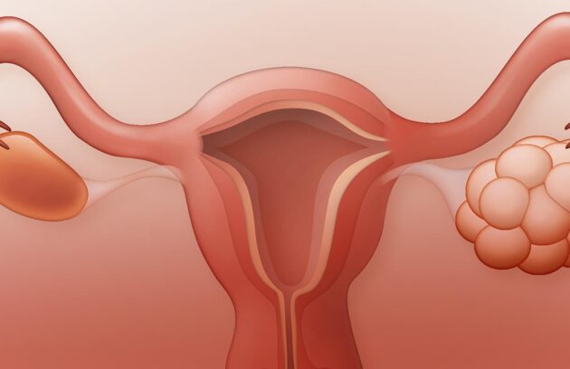 سندرم تخمدان پلی کیستیک