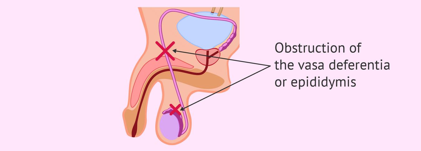 آزواسپرمی پس از بیضهای