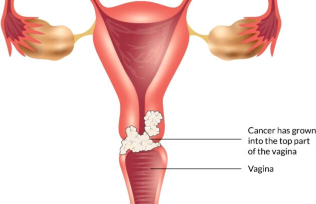 سرطان واژن | علائم، تشخیص و روش درمان