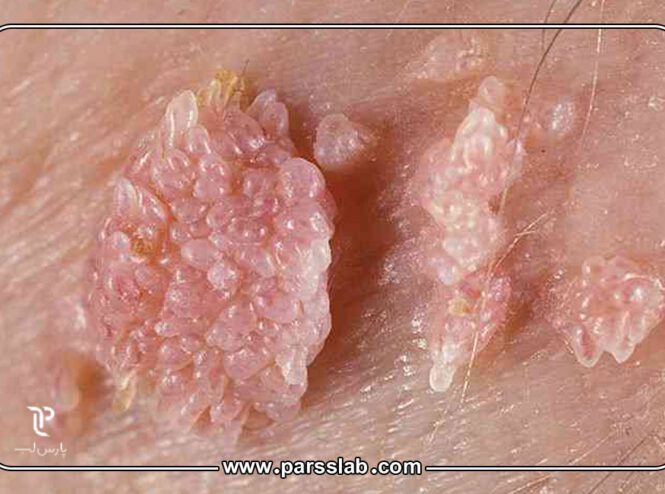 انتقال-زگیل-تناسلی