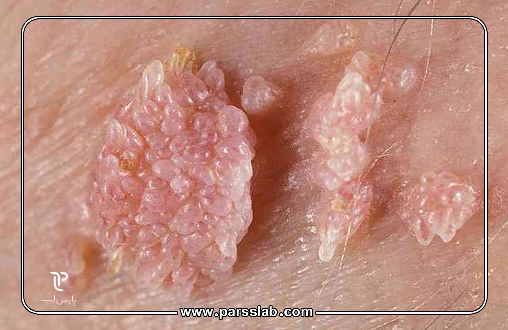 انتقال-زگیل-تناسلی